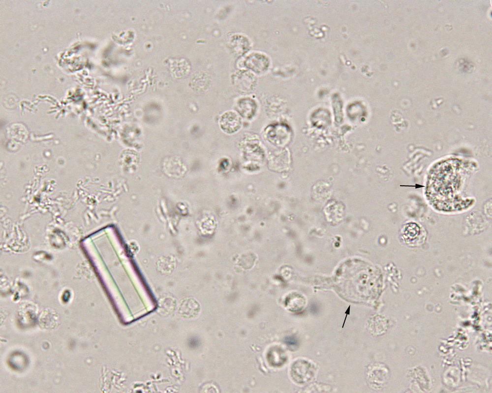 Kidney ailment Urinalysis