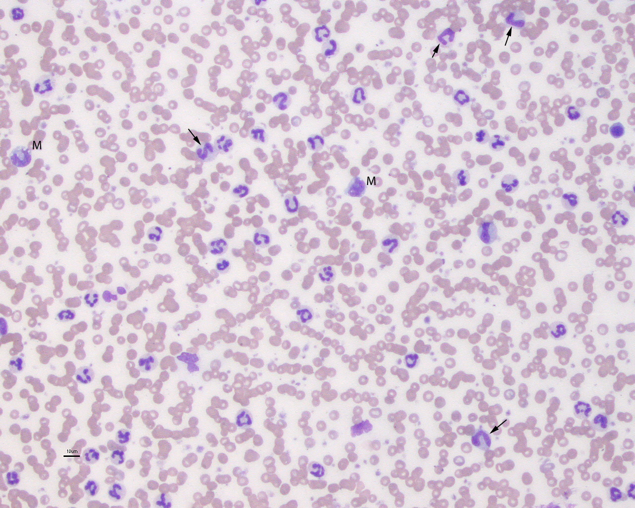 What can cause low lymphocytes and high neutrophils?